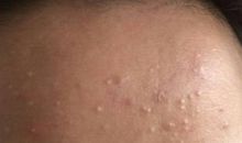 脑门上长瘤歇后语